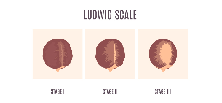 femalepattern-hair-loss-by-ludwig-scale