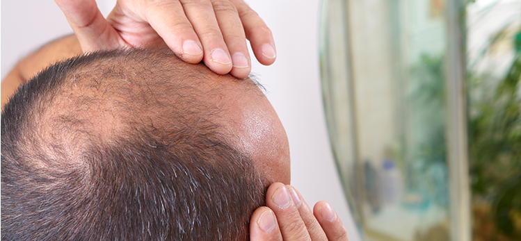 middleaged-man-concerned-hair-loss