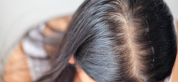 woman-problem-thin-hair