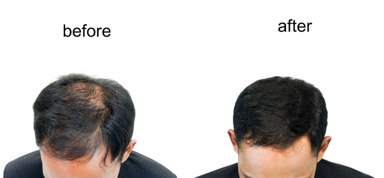 before-after-bald-head-man-on