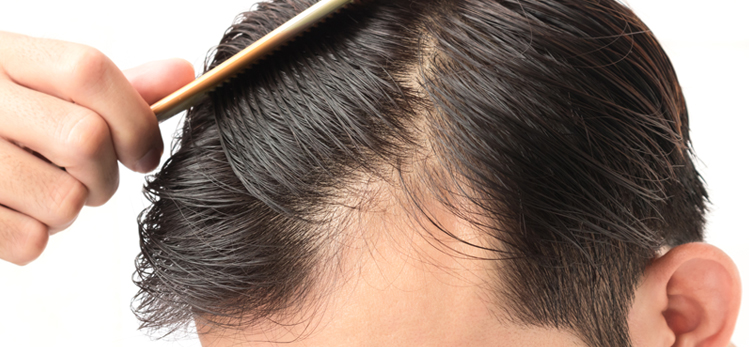 young-man-serious-hair-loss-problem