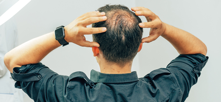 young-man-bald-spot-office-trichologist