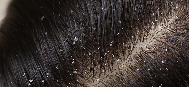 woman-dandruff-her-dark-hair-closeup